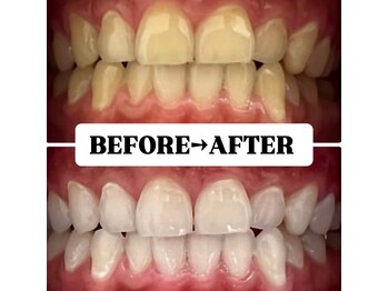 ホワイトニングサロン 豊中/Before&After美白ホワイトニング