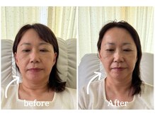 ミラ 中央林間(mira)/小顔　毛穴　ホワイトニング