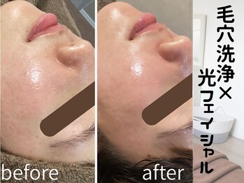 ラグレ(LUXRE)/毛穴洗浄＋光フェイシャル