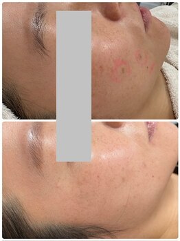 ピーナップ(P-nap)/シミ改善