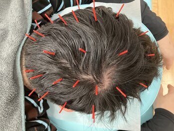 あおき鍼灸整骨院の写真/男性のための頭皮ケア鍼！頭皮のコリをほぐし、血流を整え育毛をサポート！