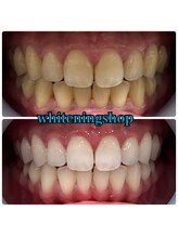 ホワイトニングショップ 加古川店/お客様のビフォーアフター