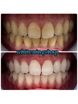 ホワイトニングショップ 加古川店/お客様のビフォーアフター