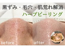 ザ サロン エスメ 二子玉川(THE SALON esme)/肌機能アップ ハーブピーリング