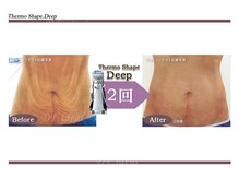 Nビューティー/最新RFサーモシェイプオーパス