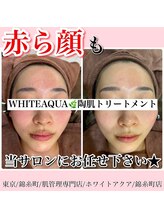 ホワイトアクア 錦糸町店(WHITE AQUA)/ハーブピーリング/東京/錦糸町