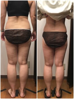 美容整体ユメカ(美容整体YUMEKA)/お腹・脚のラジオ波施術