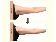 ユニクリア(Uni clear)/引き締まりのある　二の腕