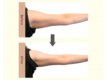 ユニクリア(Uni clear)/引き締まりのある 二の腕