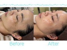 アリスのシミケアは驚きの効果！！