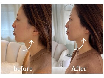 ミラ 中央林間(mira)/小顔　毛穴　ホワイトニング