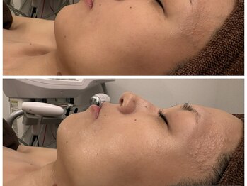 イディアル(IDE'AL)/陶肌トリートメント