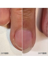 ココデネイル(cocode nail)/お悩み：深爪、爪の形が短い