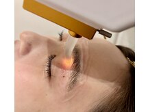 十美/眉回り光脱毛