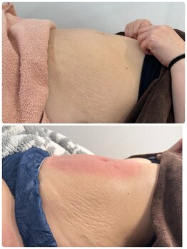 レピア(LEPIA)/脂肪冷却で引き締め
