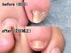 モノ。コト。時々ネイル。 bricoの写真/巻き爪、爪のトラブル、タコやウオノメ、角質等でお悩みの方はぜひご相談ください♪ホームケア用品込価格★