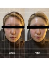 リノリー(rinory)/小顔矯正