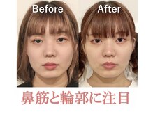 隆鼻矯正専門店 ラプリ(Raplit)/隆鼻＋輪郭矯正40分10回