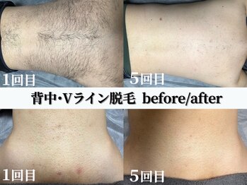 シャイン(SHINE)/背中・Vラインビフォーアフター