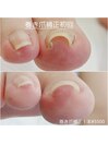 【巻き爪補正】