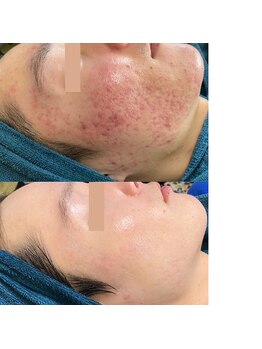 ビエン(美艶 b.en)/TIP　集中プログラム