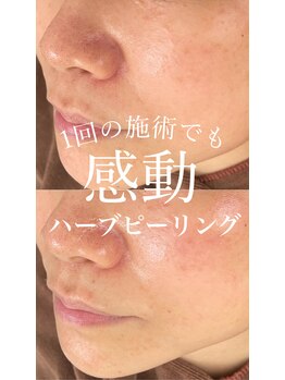 ウィンク 勝どき(wink)/#勝どきエステ#ハーブピーリング