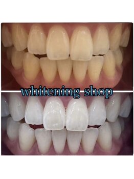 ホワイトニングショップ 和歌山店/圧倒的美白セルフホワイトニング