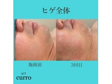 アクト クロ(ACT curro)/【ヒゲ全体】脱毛施術例