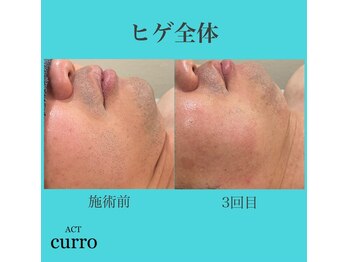 アクト クロ(ACT curro)/【ヒゲ全体】脱毛施術例