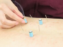 押上接骨鍼灸マッサージ院/鍼とお灸