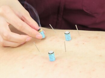 押上接骨鍼灸マッサージ院/鍼とお灸