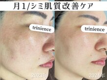 トリニエンス 新宿店(TRINIENCE)/40代/シミケア/年齢肌ケア