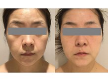 リンク 錦糸町店(Link)/BHF×6回（32歳）