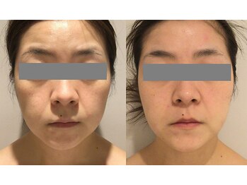 リンク 錦糸町店(Link)/BHF×6回（32歳）