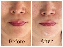 【肌を育てるピーリング】艶肌ララピール 初回12000円→9800円