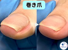 プラスワンフット 本厚木(+1 Foot)/巻き爪矯正は専門店へ●