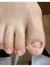 フットメンテ 巻き爪矯正センター 南浦和/変形爪　初回施術後