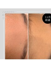 ヴィヴィオドット(vivio.)/顔脱毛