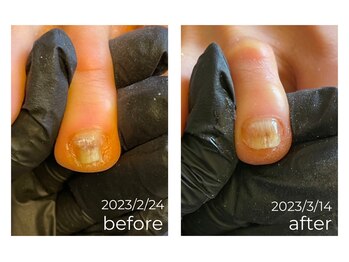 肥厚爪/巻爪《O様右足人差し指》