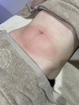 シャリテ(Charite)/冷却後のお腹