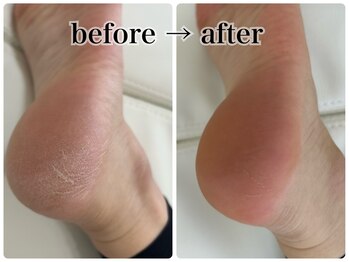 ネイルモア 藤が丘店(nail mor.)/フット角質ケア