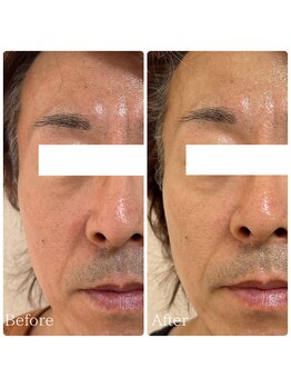 エース(ACE.)/たるみ改善☆ハーブピーリング