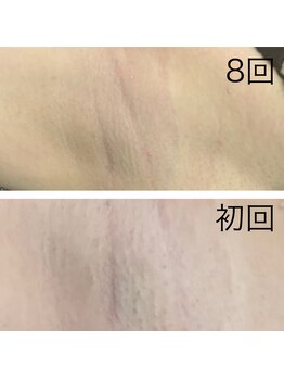 レイモード(Ray mode)/脇脱毛