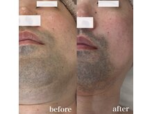 コアラッシュ(COA LASH)/GRANDIPL 脱毛