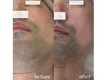 コアラッシュ(COA LASH)/GRANDIPL 脱毛