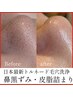 【毛穴の黒ずみ徹底除去★】日本初採用・トルネード式毛穴洗浄で毛穴レスへ♪