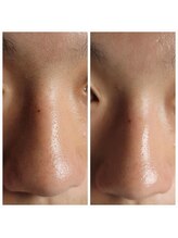 ラデュープラス(Radieux+)/MEN‘S　【韓国式３D毛穴洗浄】