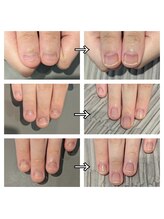 エムスラッシュ ネイル センター北店(M.SLASH)/育爪コース!2ヶ月後の変化!