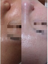 サロンド エステ ミニョン(salon de esthe mignon)/ガリレオピーリングと炭酸パック