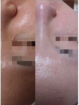 サロンド エステ ミニョン(salon de esthe mignon)/ガリレオピーリングと炭酸パック